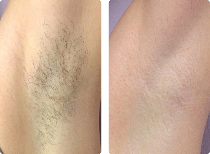 Underarm diode laser hair removal before and after results at CP Praxis Basel
