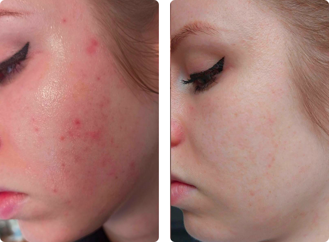 Acne treatment before and after results at CP Praxis Basel and Bottmingen