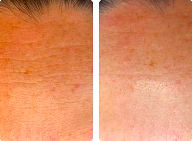 Skin before an anti-ageing treatment at CP Praxis Basel and Bottmingen