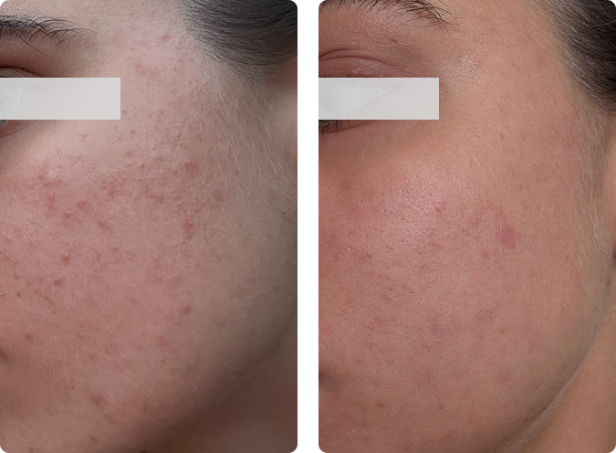 Manual deep cleansing before and after results at CP Praxis Basel and Bottmingen showing cleaner pores and reduced blackheads