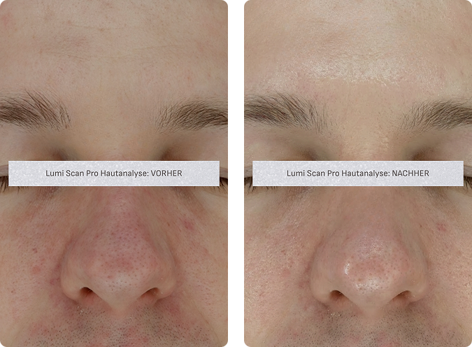 Skin before an anti-ageing treatment at CP Praxis Basel and Bottmingen