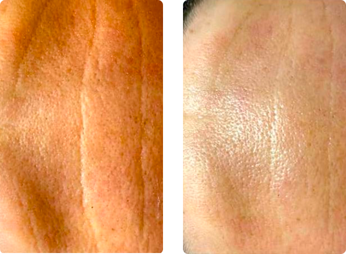 Dehydrated skin texture before and after professional hydration peel treatment at CP Praxis Basel