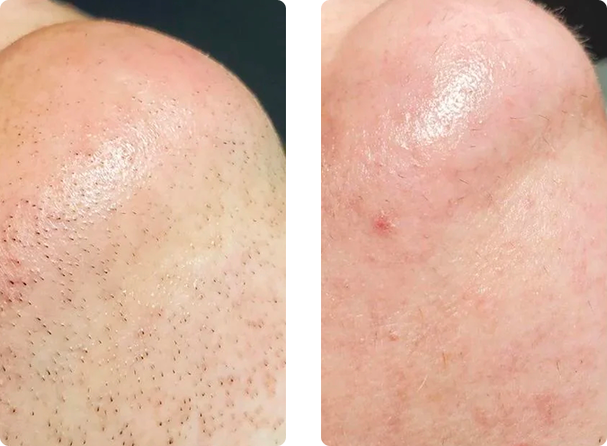 Electroepilation before and after results at CP Praxis Basel and Bottmingen. Permanent hair removal with Apilus xCell showing visible reduction after treatment.