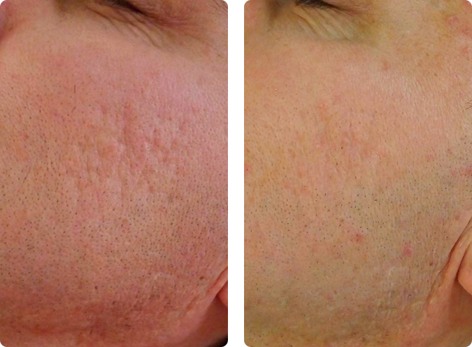 Mesotherapy before and after results at CP Praxis Basel and Bottmingen