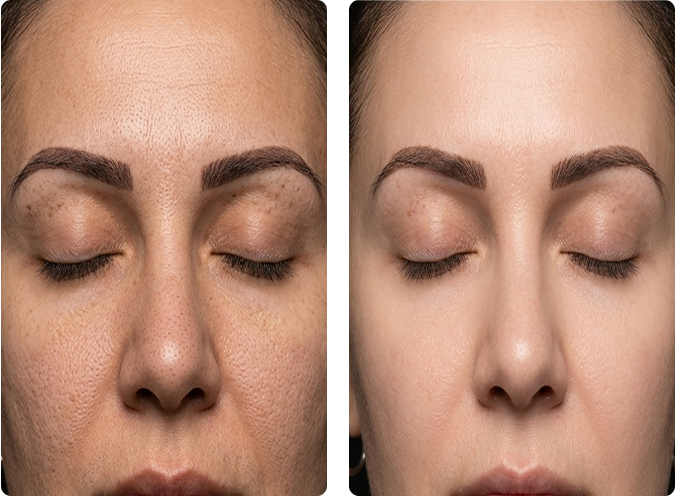 Microneedling before and after results at CP Praxis Basel, pigmentation and skin texture improvement