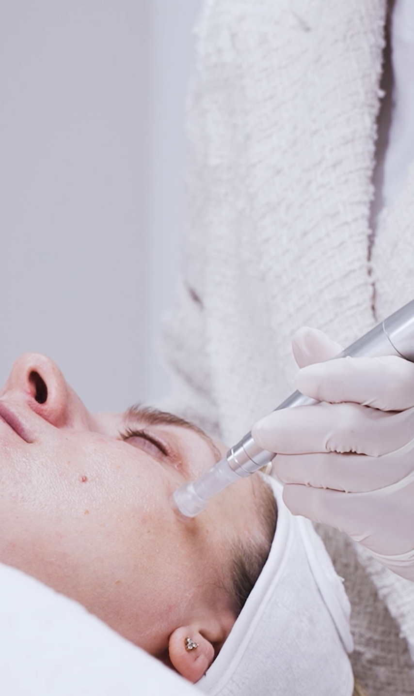 Microneedling facial treatment at CP Praxis Base and Bottmingen