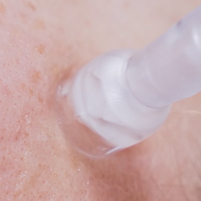 Microneedling pen treatment at CP Praxis Basel and Bottmingen