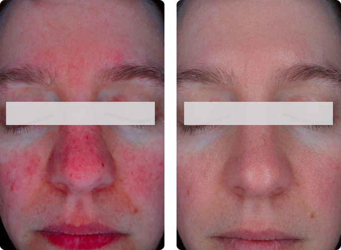 Nanoneedling before and after results at CP Praxis Basel and Bottmingen, pigmentation and skin texture improvement