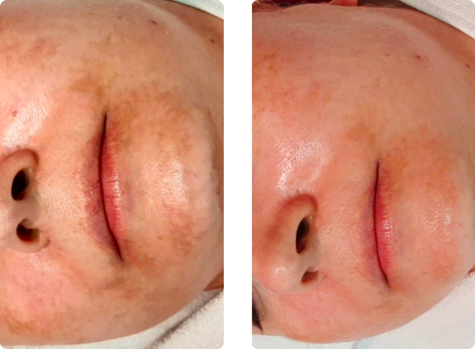 Age spots and pigmentation before and after brightening peel at CP Praxis Basel