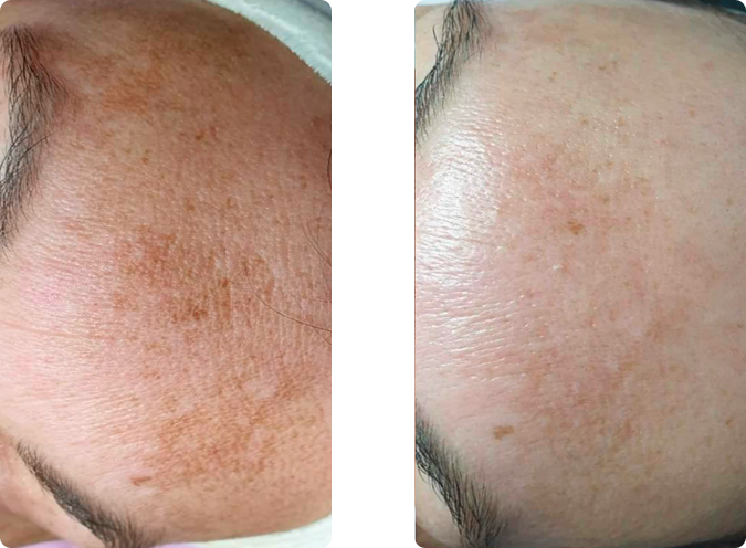 Pigmentation treatment before and after results at CP Praxis Basel and Bottmingen