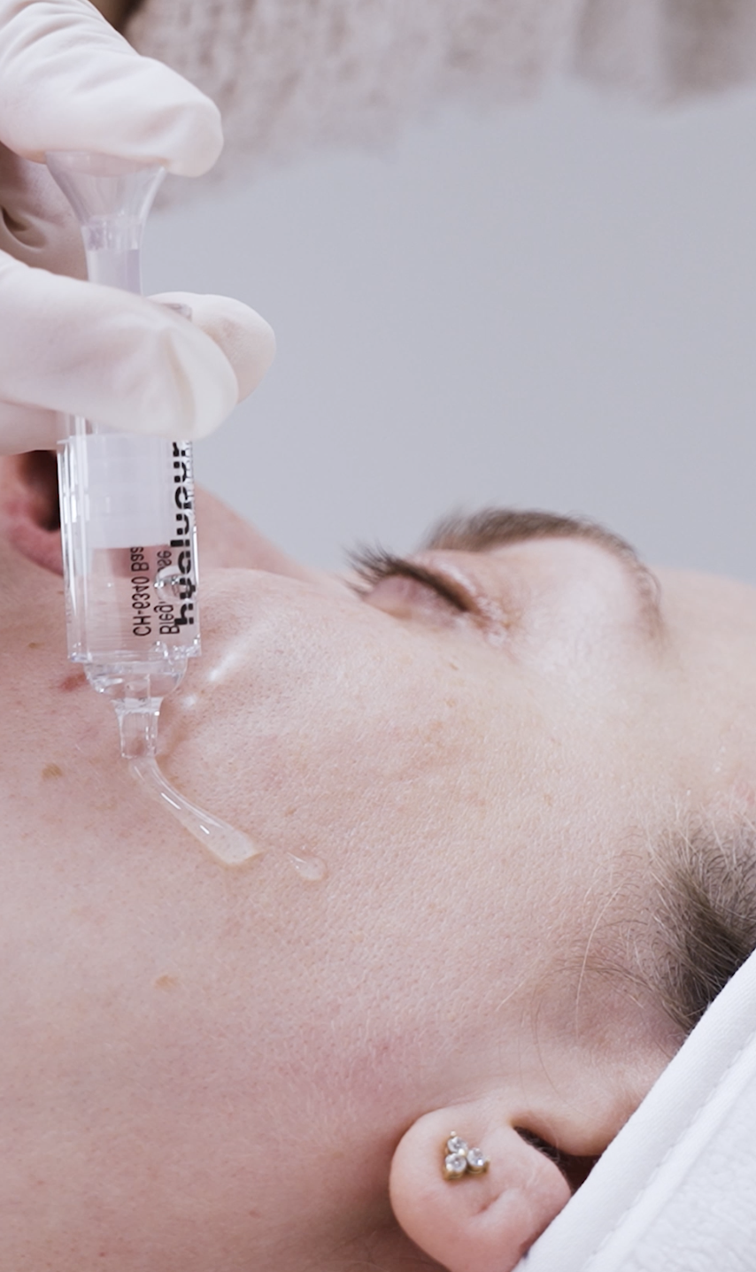 Chemical peel applied to pigmentation spots on cheek at CP Praxis Basel