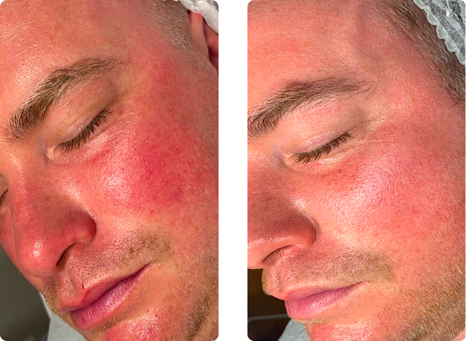 Sensitive skin before and after treatment CP Praxis Basel Bottmingen