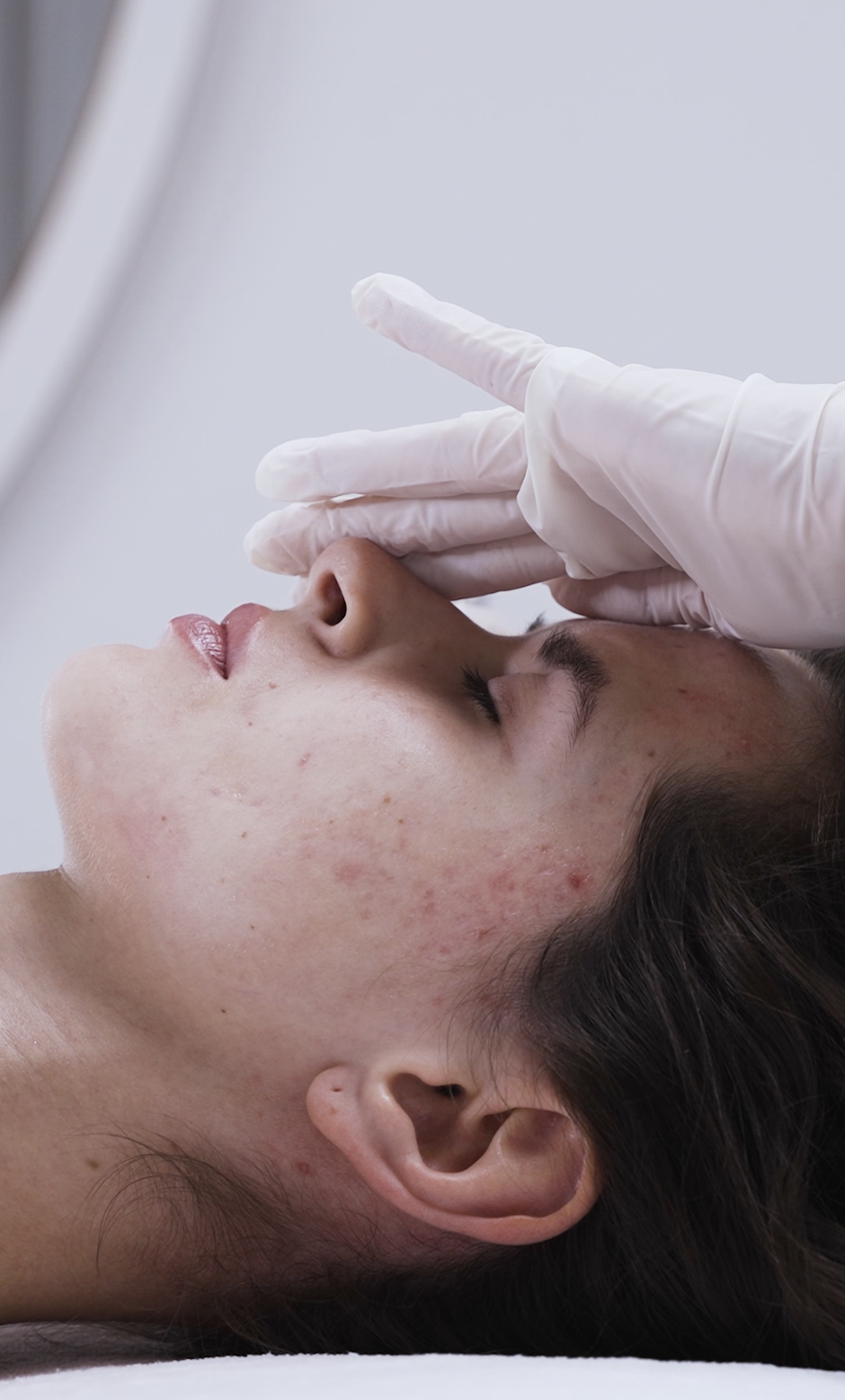 Professional acne treatment at CP Praxis Basel and Bottmingen