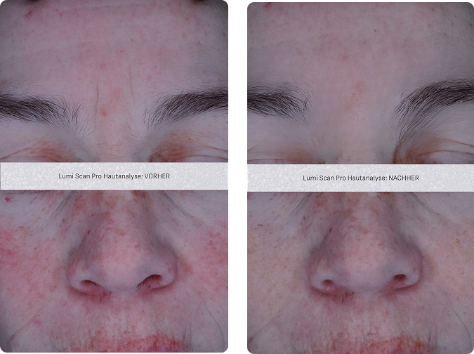 Skin inflammation and redness treatment results – before and after diagnostic analysis
