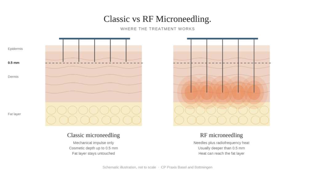 Schema zum Vergleich von klassischem Microneedling bis 0,5 mm und RF Microneedling, bei dem die Wärme die Fettschicht erreichen kann