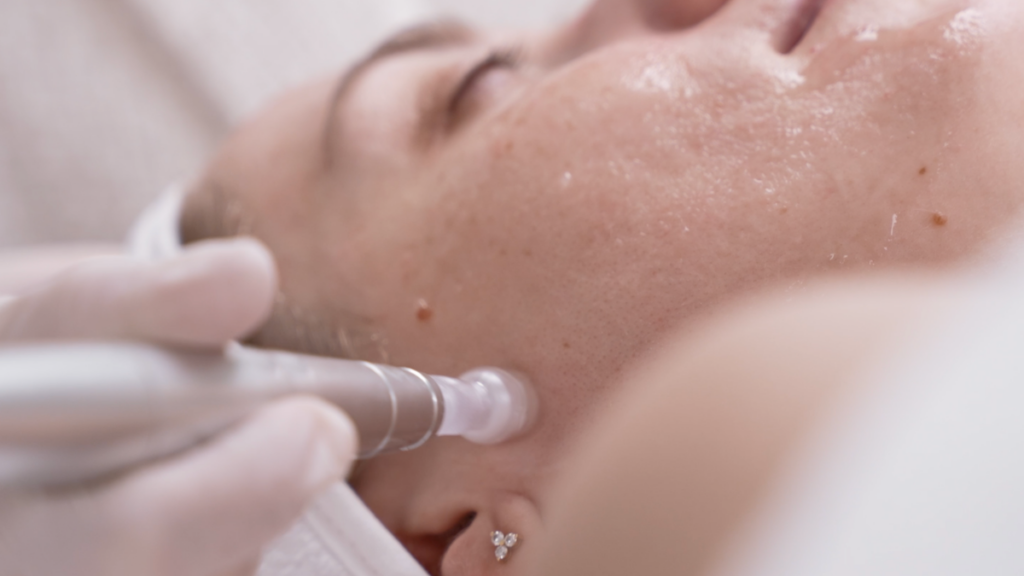 Professionelles Microneedling mit dem Schweizer Gerät dermaneed in der CP Praxis Basel