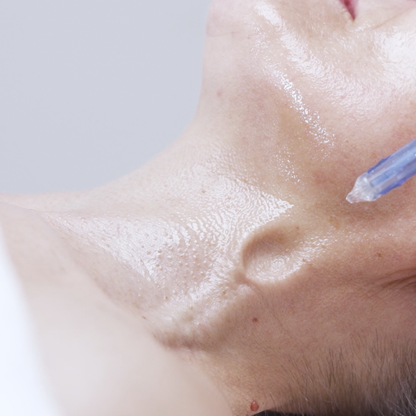 JetPeel treatment at CP Praxis in Basel