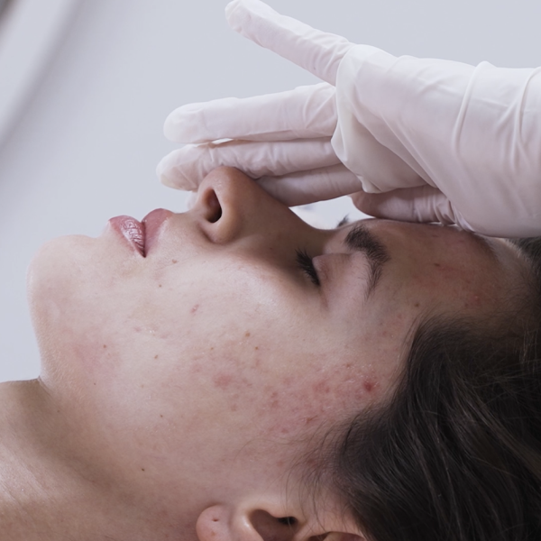 Professional acne treatment at CP Praxis Basel and Bottmingen