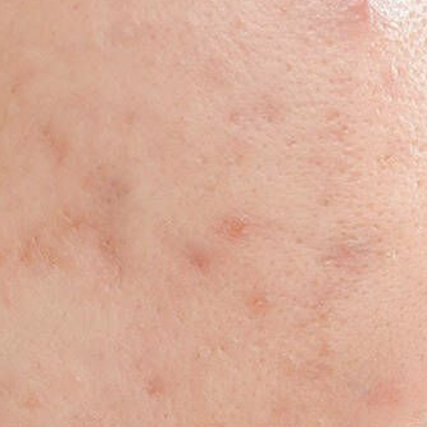 acne_skin_treatment_basel_bottmingen