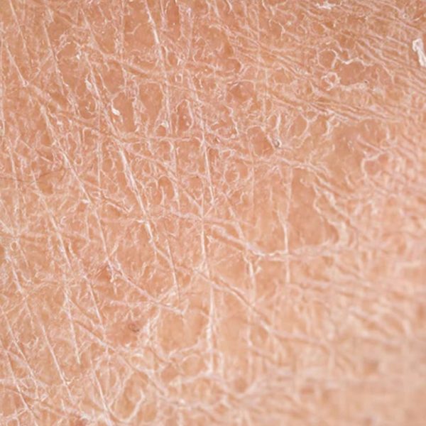 dry_skin_treatment_basel_bottmingen
