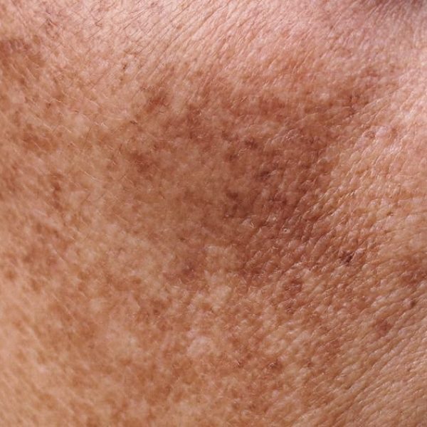pigmentation_skin_treatment_basel_bottmingen