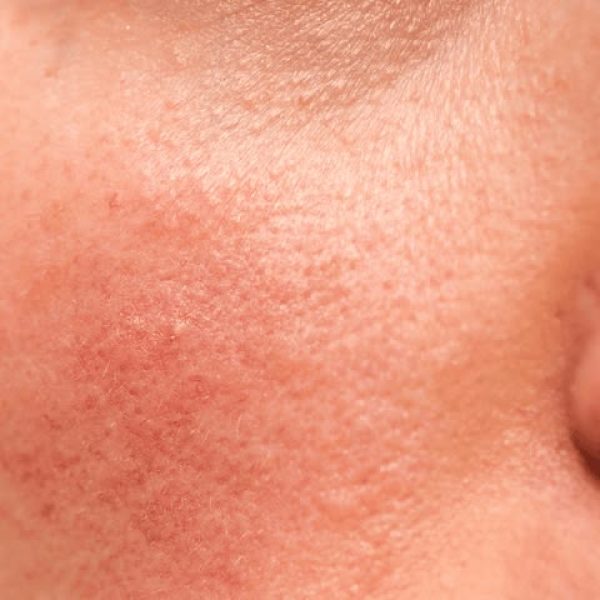 sensitive_skin_treatment_basel_bottmingen