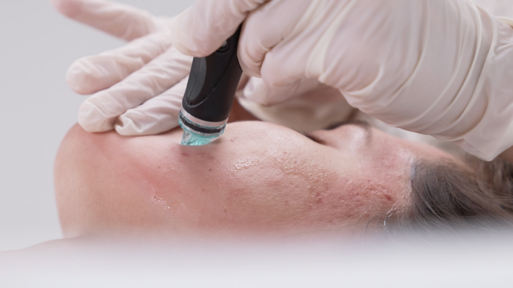 Hydrafacial: What the Science Actually Shows, and How to Spot the Original (2026) CP Praxis