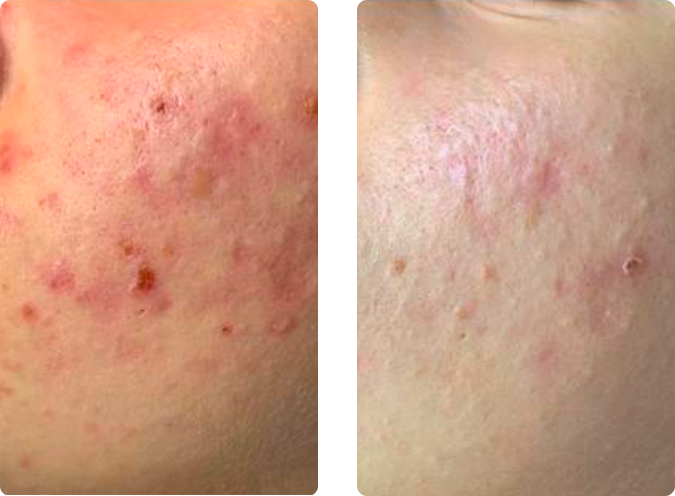 iS Clinical facial before and after results – acne and redness treatment at CP Praxis Basel