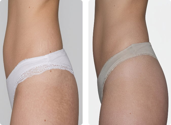 LPG Endermologie vorher und nachher nach 10 Sitzungen, straffere Hüften und definierte Taille, CP Praxis Basel