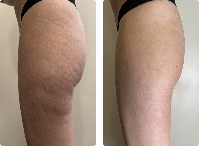 LPG Endermologie vorher und nachher nach 15 Sitzungen, glattere Oberschenkel und weniger Cellulite, CP Praxis Basel