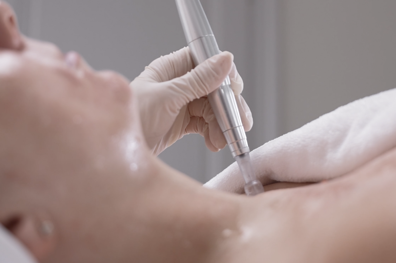 Microneedling treatment at CP Praxis Basel and Bottmingen