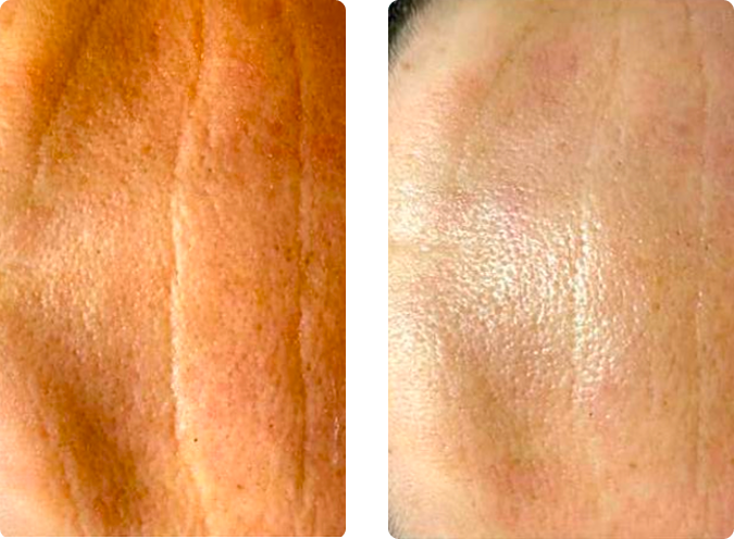 Stirnfalten und Hautstruktur vor und nach einer Microneedling Kur in der CP Praxis Basel