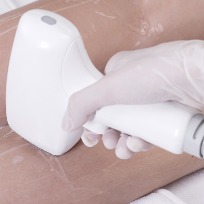 Permanent Laser Hair Removal Results Basel CP Praxis